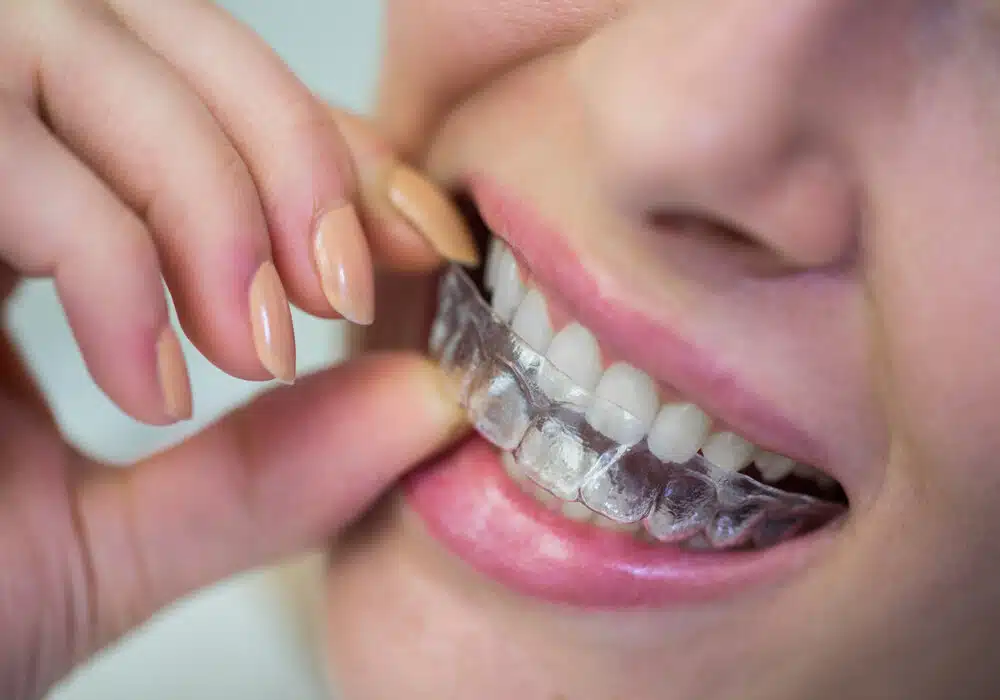 Quel est le prix d&rsquo;une facette dentaire et en vaut-elle la peine ?